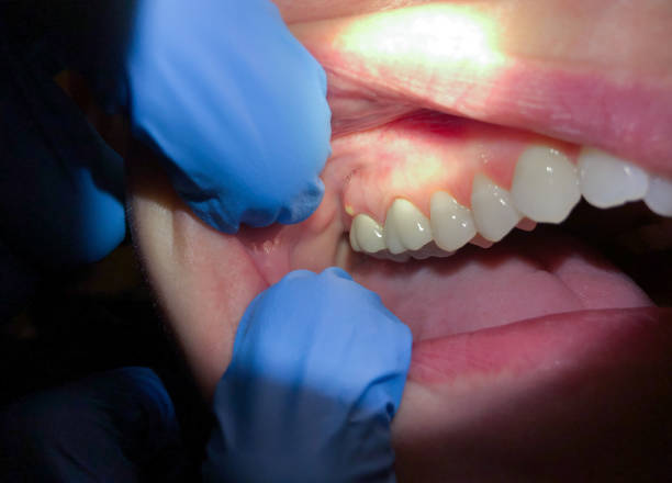 Best Emergency Dentist for Lost Fillings or Crowns in Sparkill, NY