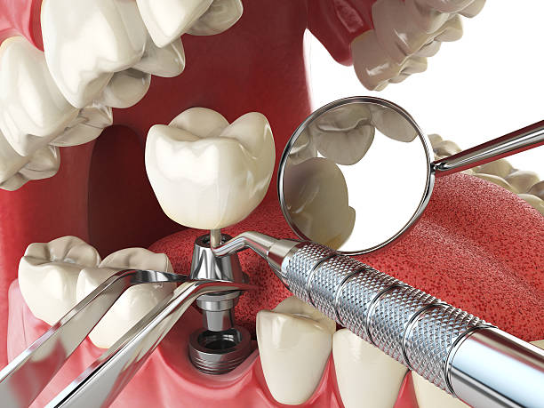 Best Emergency Dentist for Knocked-Out Tooth in Sparkill, NY